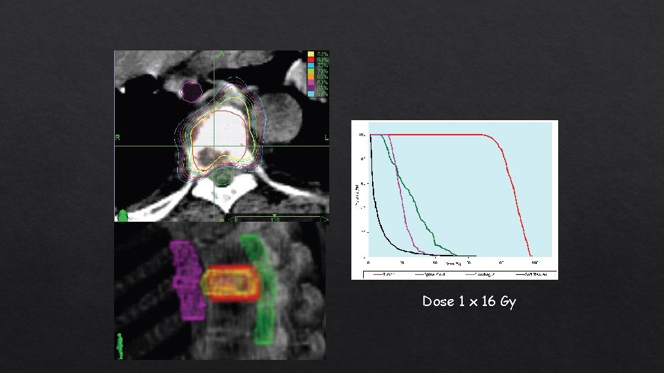 Dose 1 x 16 Gy 