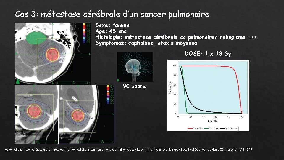 Cas 3: métastase cérébrale d’un cancer pulmonaire Sexe: femme Age: 45 ans Histologie: métastase