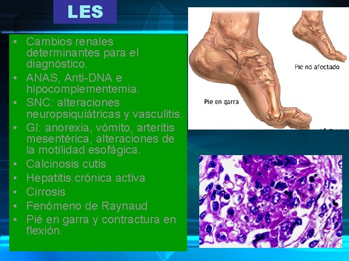 LES • Cambios renales determinantes para el diagnóstico. • ANAS, Anti-DNA e hipocomplementemia. •