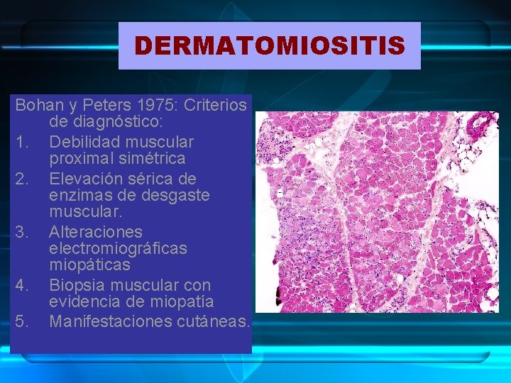 DERMATOMIOSITIS Bohan y Peters 1975: Criterios de diagnóstico: 1. Debilidad muscular proximal simétrica 2.