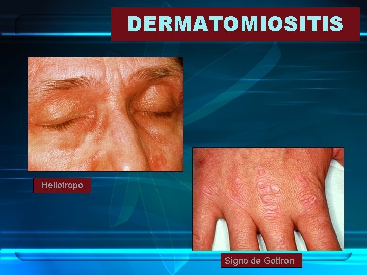 DERMATOMIOSITIS Heliotropo Signo de Gottron 