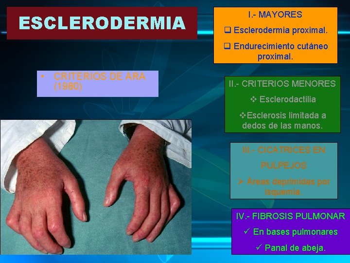 ESCLERODERMIA I. - MAYORES q Esclerodermia proximal. q Endurecimiento cutáneo proximal. • CRITERIOS DE