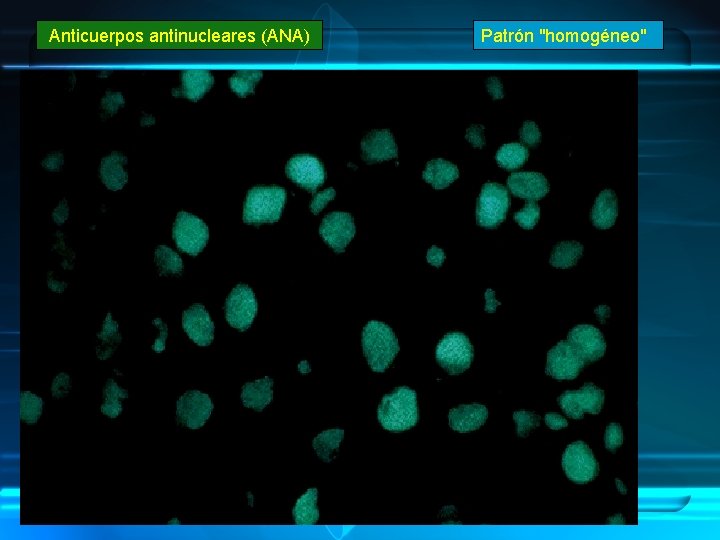 Anticuerpos antinucleares (ANA) Patrón "homogéneo" 