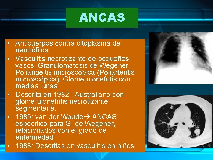 ANCAS • Anticuerpos contra citoplasma de neutrófilos. • Vasculitis necrotizante de pequeños vasos: Granulomatosis