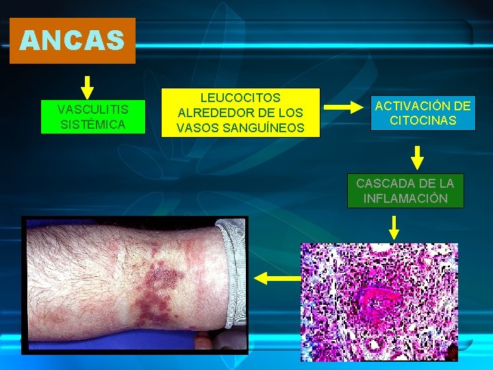 ANCAS VASCULITIS SISTÉMICA LEUCOCITOS ALREDEDOR DE LOS VASOS SANGUÍNEOS ACTIVACIÓN DE CITOCINAS CASCADA DE