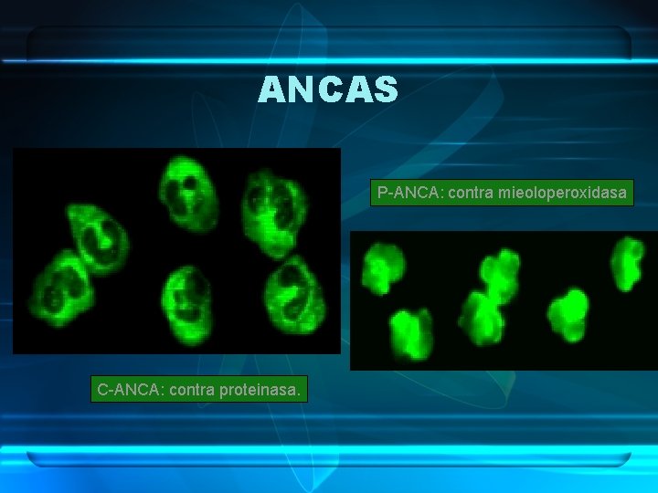 ANCAS P-ANCA: contra mieoloperoxidasa C-ANCA: contra proteinasa. 