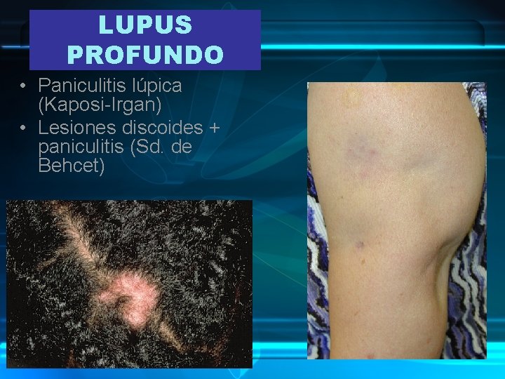LUPUS PROFUNDO • Paniculitis lúpica (Kaposi-Irgan) • Lesiones discoides + paniculitis (Sd. de Behcet)