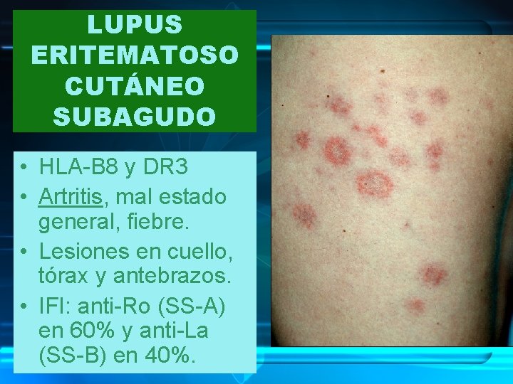 LUPUS ERITEMATOSO CUTÁNEO SUBAGUDO • HLA-B 8 y DR 3 • Artritis, mal estado