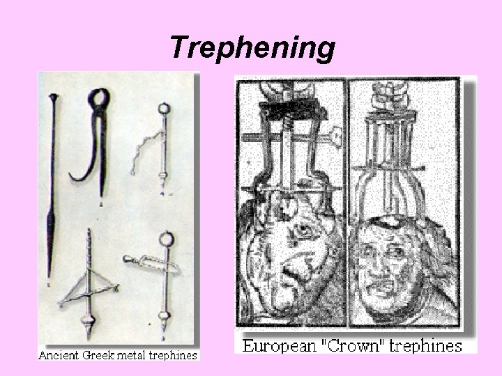 Trephening 