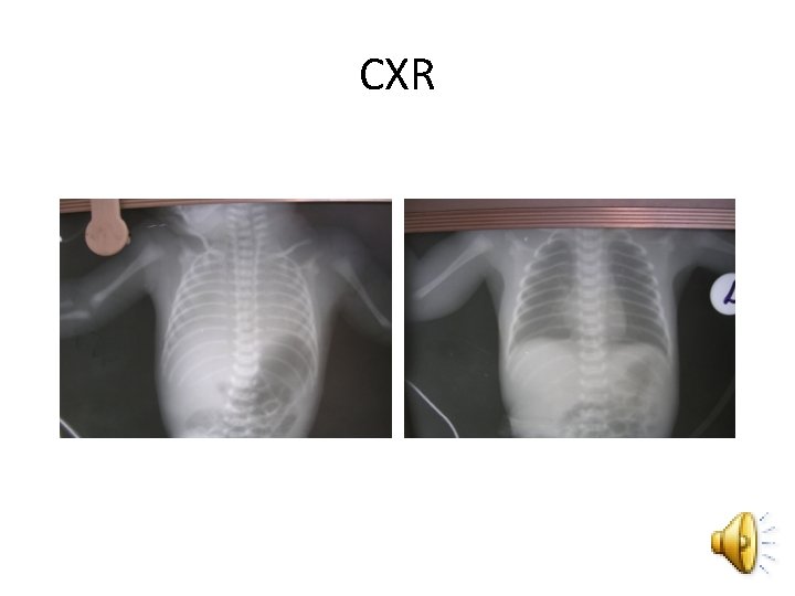 CXR 