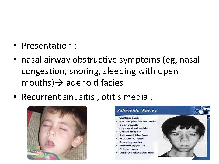  • Presentation : • nasal airway obstructive symptoms (eg, nasal congestion, snoring, sleeping