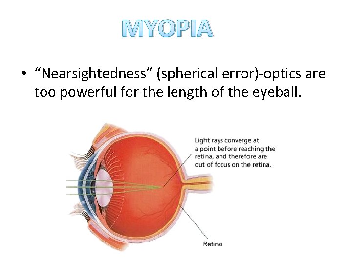 MYOPIA • “Nearsightedness” (spherical error)-optics are too powerful for the length of the eyeball.