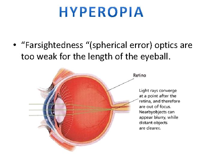  • “Farsightedness “(spherical error) optics are too weak for the length of the
