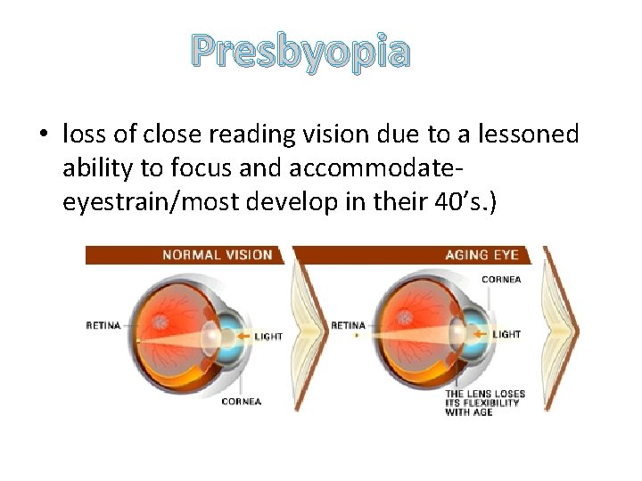Presbyopia • loss of close reading vision due to a lessoned ability to focus