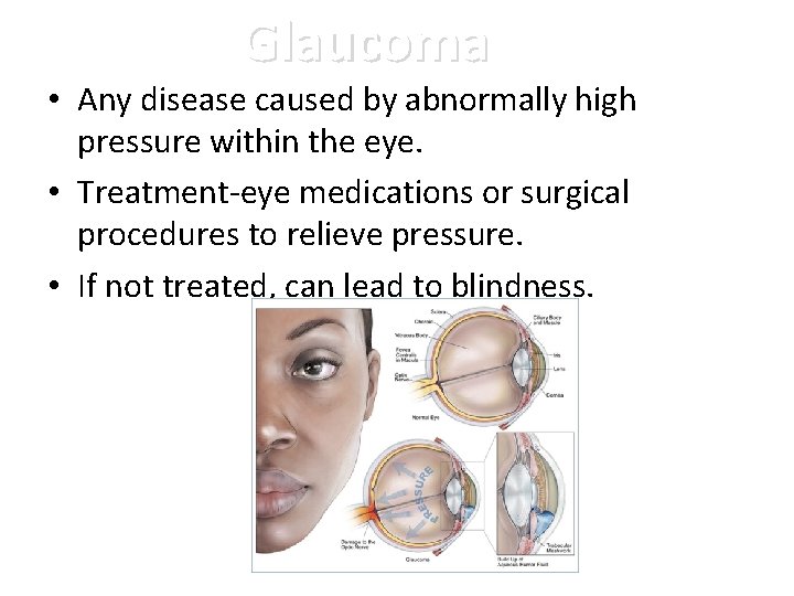 Glaucoma • Any disease caused by abnormally high pressure within the eye. • Treatment-eye