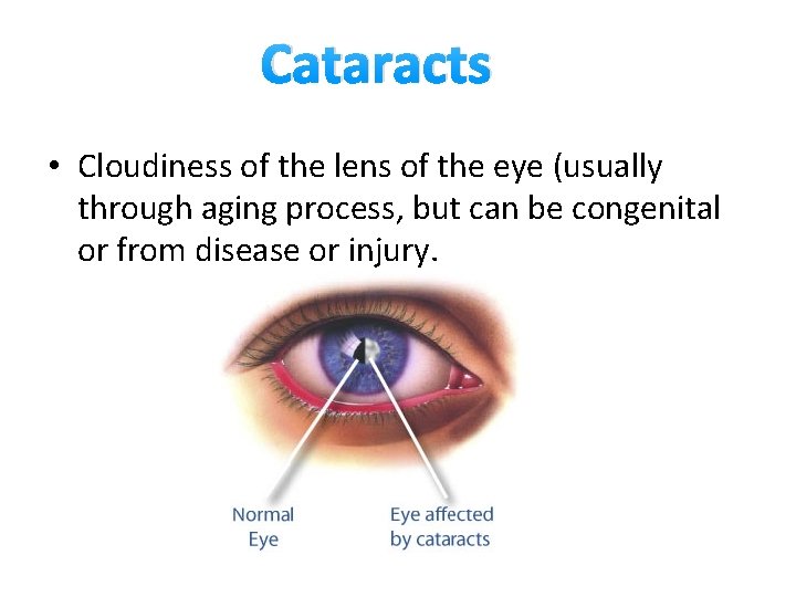 Cataracts • Cloudiness of the lens of the eye (usually through aging process, but