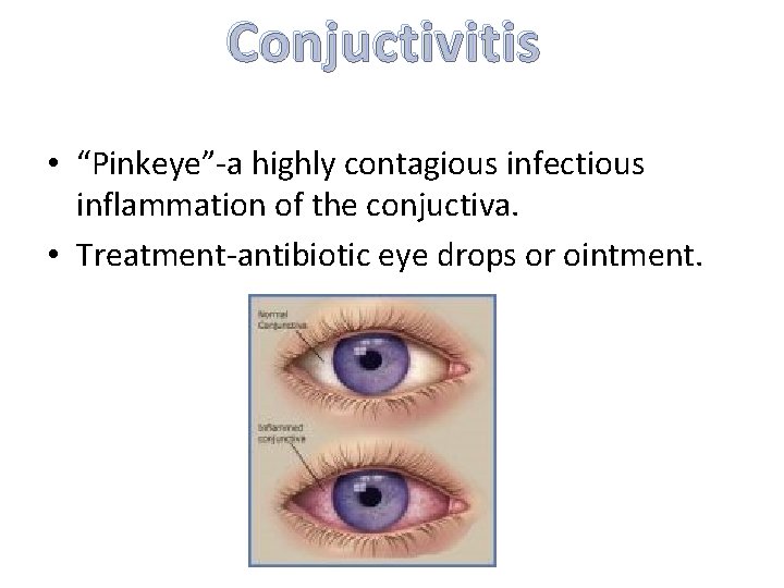 Conjuctivitis • “Pinkeye”-a highly contagious infectious inflammation of the conjuctiva. • Treatment-antibiotic eye drops