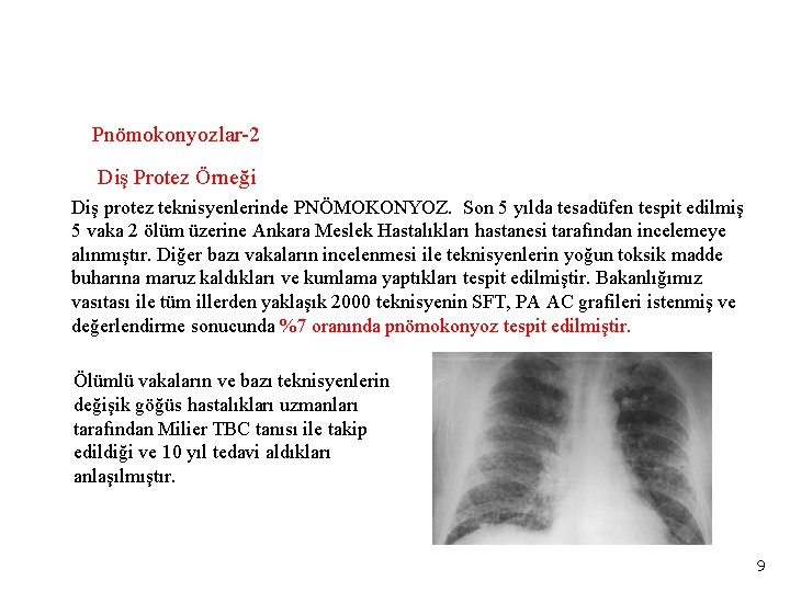 Pnömokonyozlar-2 Diş Protez Örneği Diş protez teknisyenlerinde PNÖMOKONYOZ. Son 5 yılda tesadüfen tespit edilmiş