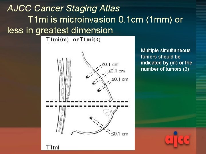 AJCC Cancer Staging Atlas T 1 mi is microinvasion 0. 1 cm (1 mm)