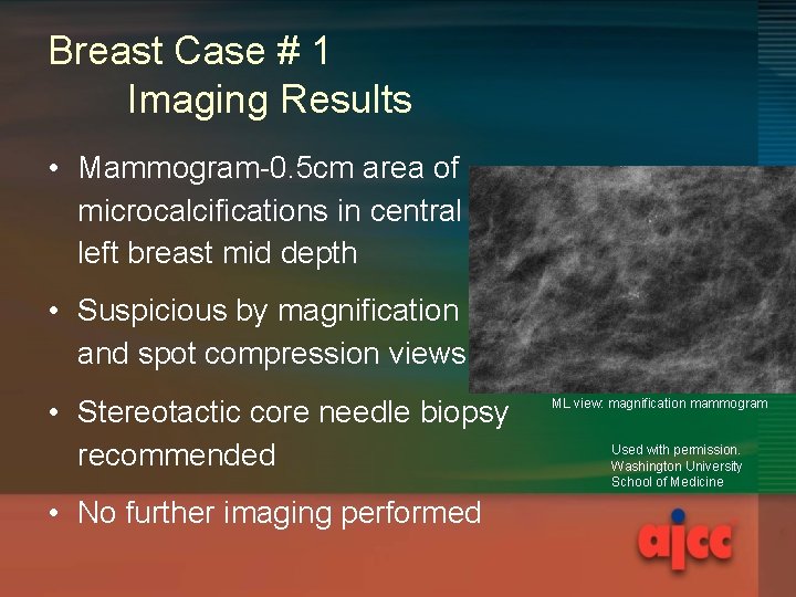 Breast Case # 1 Imaging Results • Mammogram-0. 5 cm area of microcalcifications in