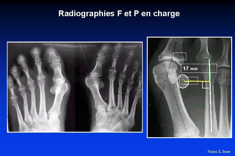 Radiographies F et P en charge 17 mm 7 Photos JL Besse 