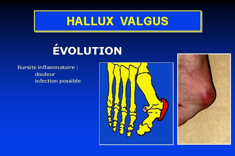 HALLUX VALGUS ÉVOLUTION Bursite inflammatoire : douleur infection possible 