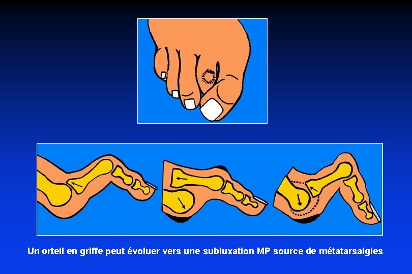 Un orteil en griffe peut évoluer vers une subluxation MP source de métatarsalgies 