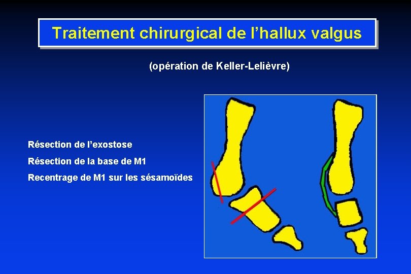 Traitement chirurgical de l’hallux valgus (opération de Keller-Lelièvre) Résection de l’exostose Résection de la