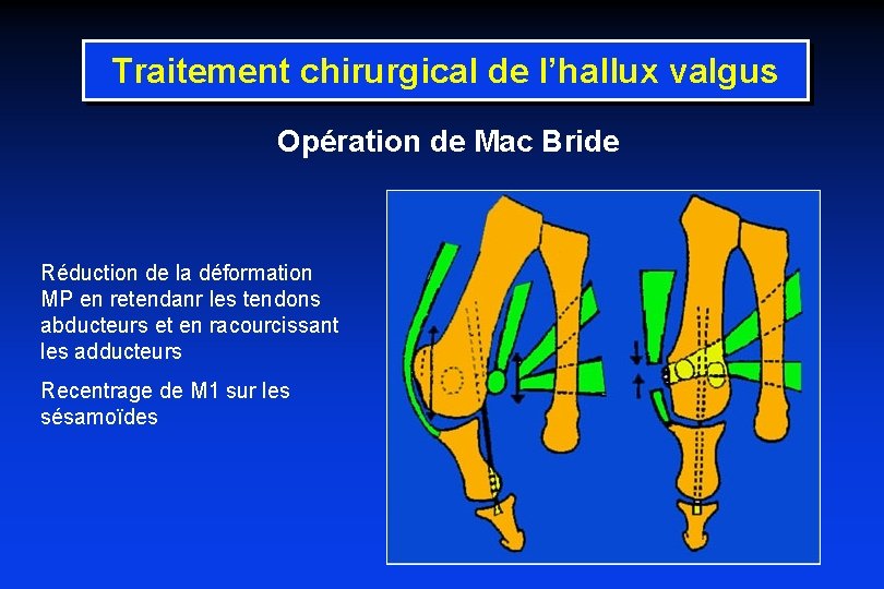 Traitement chirurgical de l’hallux valgus Opération de Mac Bride Réduction de la déformation MP
