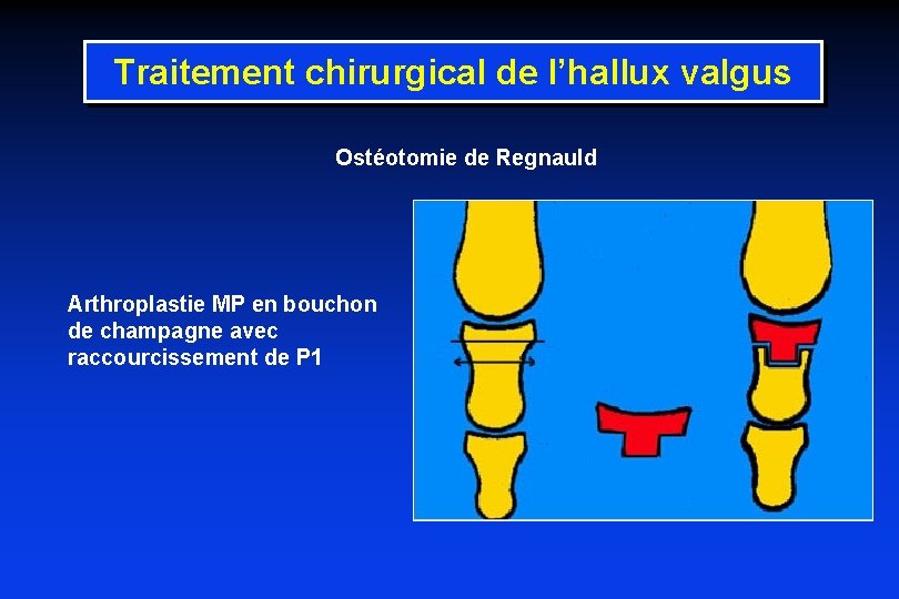Traitement chirurgical de l’hallux valgus Ostéotomie de Regnauld Arthroplastie MP en bouchon de champagne