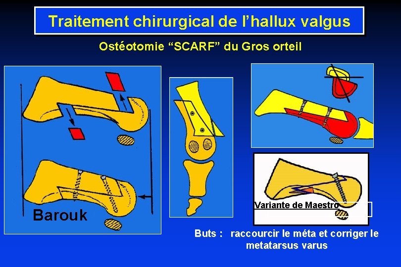 Traitement chirurgical de l’hallux valgus Ostéotomie “SCARF” du Gros orteil Barouk Variante de Maestro