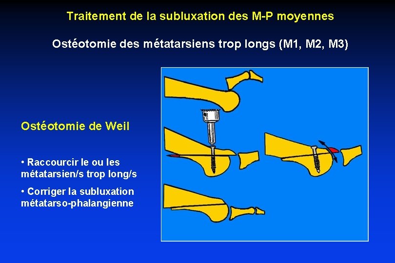 Traitement de la subluxation des M-P moyennes Ostéotomie des métatarsiens trop longs (M 1,