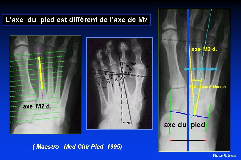 L’axe du pied est différent de l’axe de M 2 axe M 2 d.