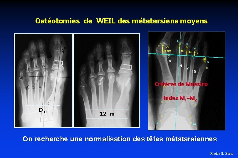 Ostéotomies de WEIL des métatarsiens moyens D 0 12 m On recherche une normalisation