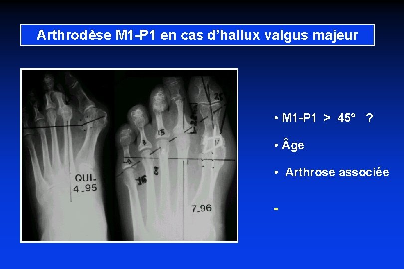 Arthrodèse M 1 -P 1 en cas d’hallux valgus majeur • M 1 -P