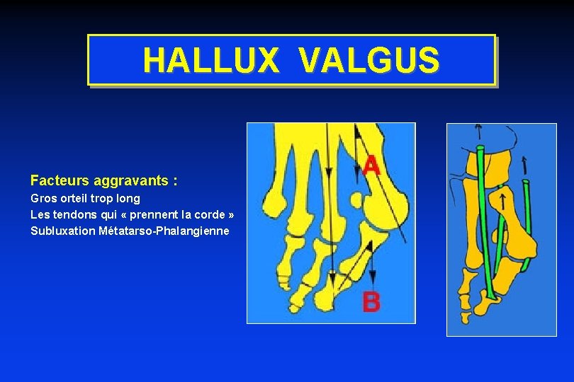 HALLUX VALGUS Facteurs aggravants : Gros orteil trop long Les tendons qui « prennent