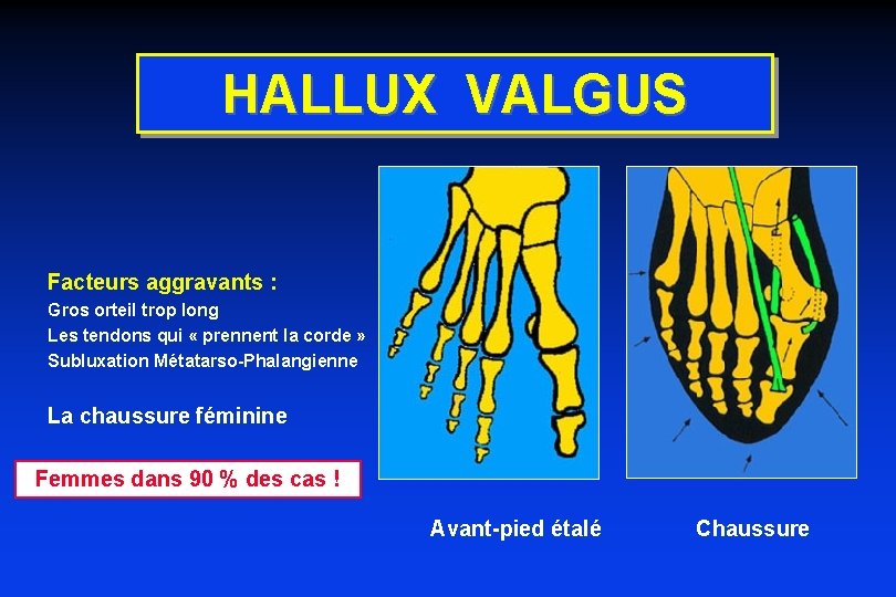 HALLUX VALGUS Facteurs aggravants : Gros orteil trop long Les tendons qui « prennent