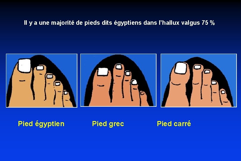 Il y a une majorité de pieds dits égyptiens dans l’hallux valgus 75 %