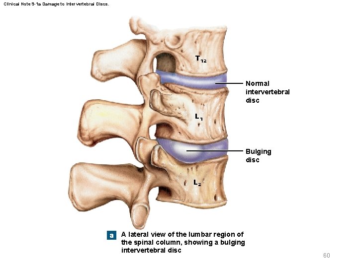 Clinical Note 9 -1 a Damage to Intervertebral Discs. T 12 Normal intervertebral disc