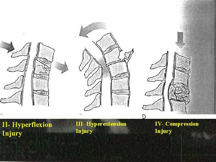 II- Hyperflexion Injury III- Hyperextension Injury IV- Compression Injury 