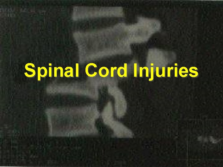 Spinal Cord Injuries 