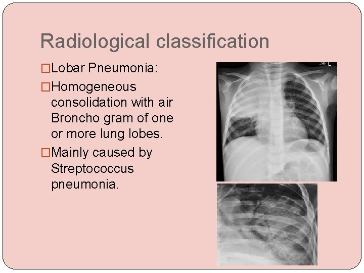 Radiological classification �Lobar Pneumonia: �Homogeneous consolidation with air Broncho gram of one or more