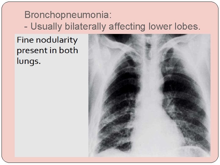 Bronchopneumonia: - Usually bilaterally affecting lower lobes. 