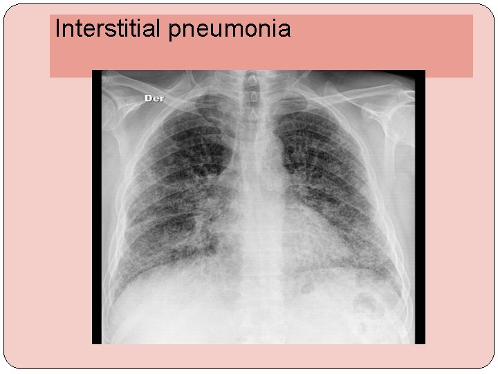 Interstitial pneumonia 