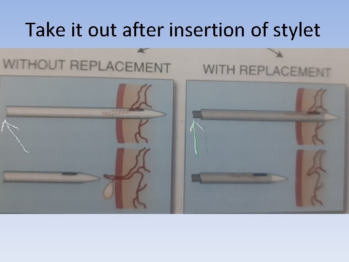 Take it out after insertion of stylet 