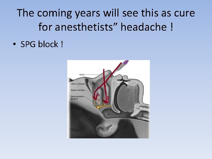 The coming years will see this as cure for anesthetists” headache ! • SPG