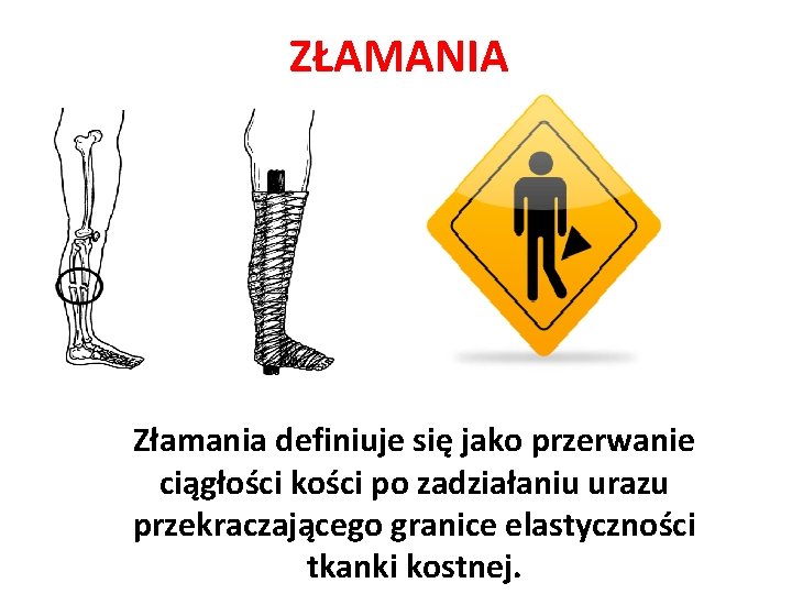 ZŁAMANIA Złamania definiuje się jako przerwanie ciągłości kości po zadziałaniu urazu przekraczającego granice elastyczności