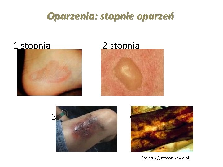 Oparzenia: stopnie oparzeń 1 stopnia 2 stopnia 3 stopnia 4 stopnia Fot. http: //ratownikmed.