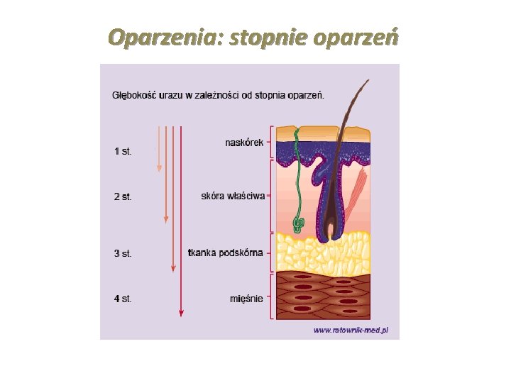Oparzenia: stopnie oparzeń Oparzenia: stopnie oparzeń