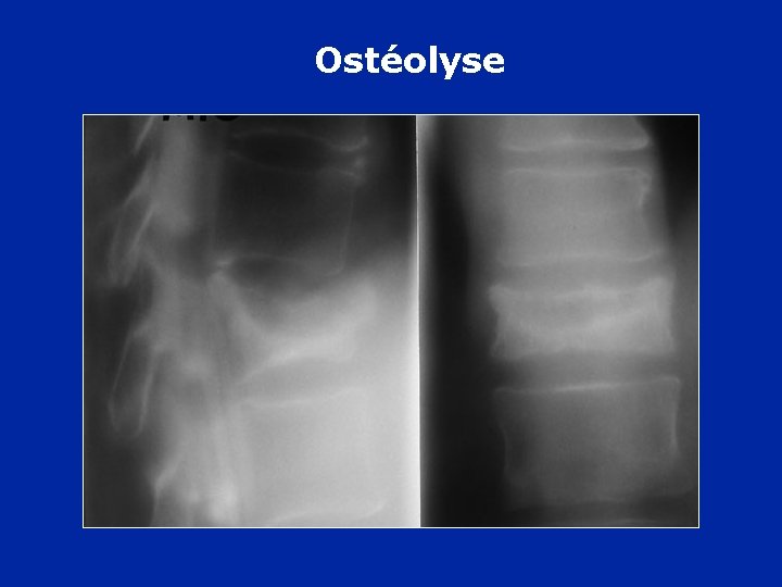 Ostéolyse 